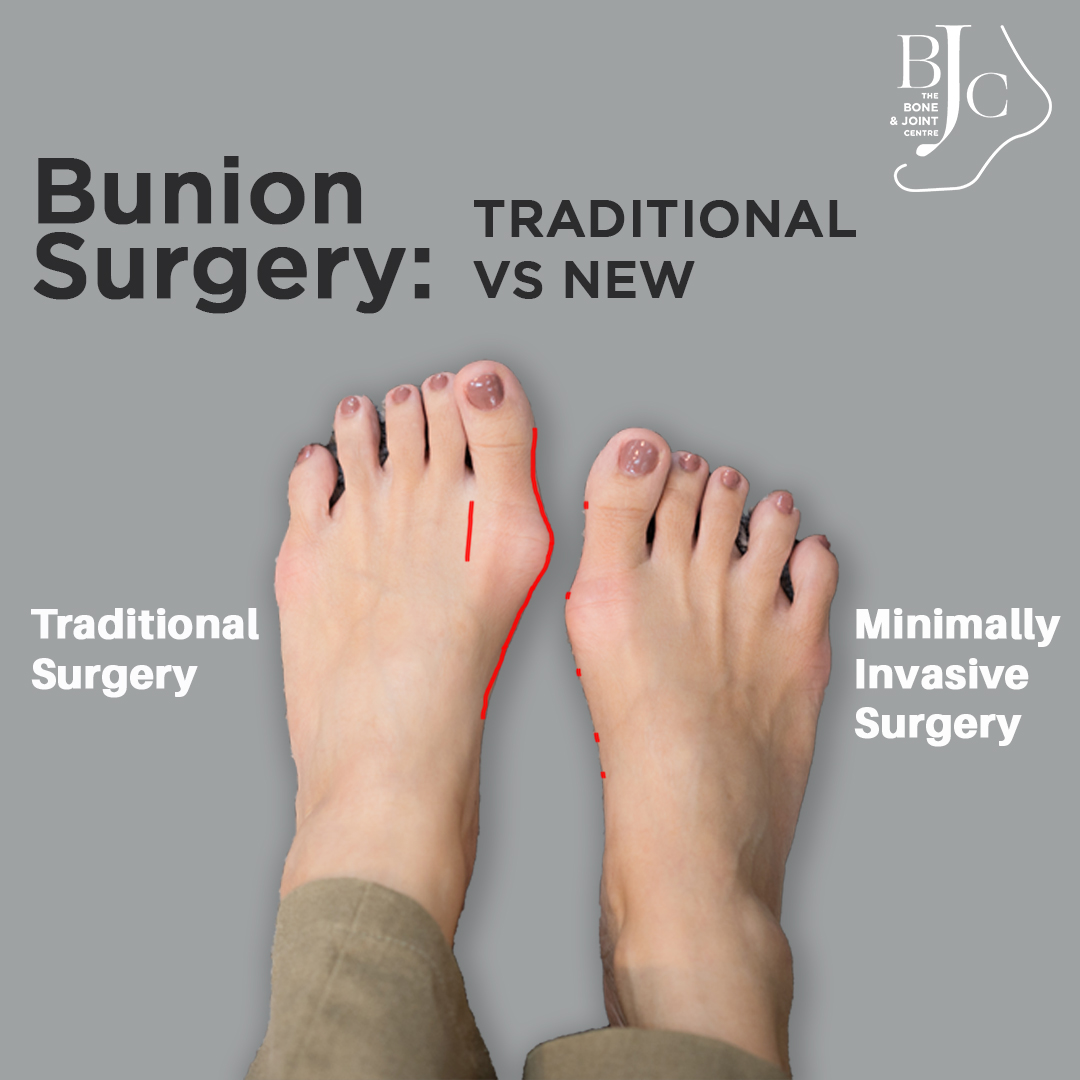 Bunion Surgeon - Bunion Treatment Singapore